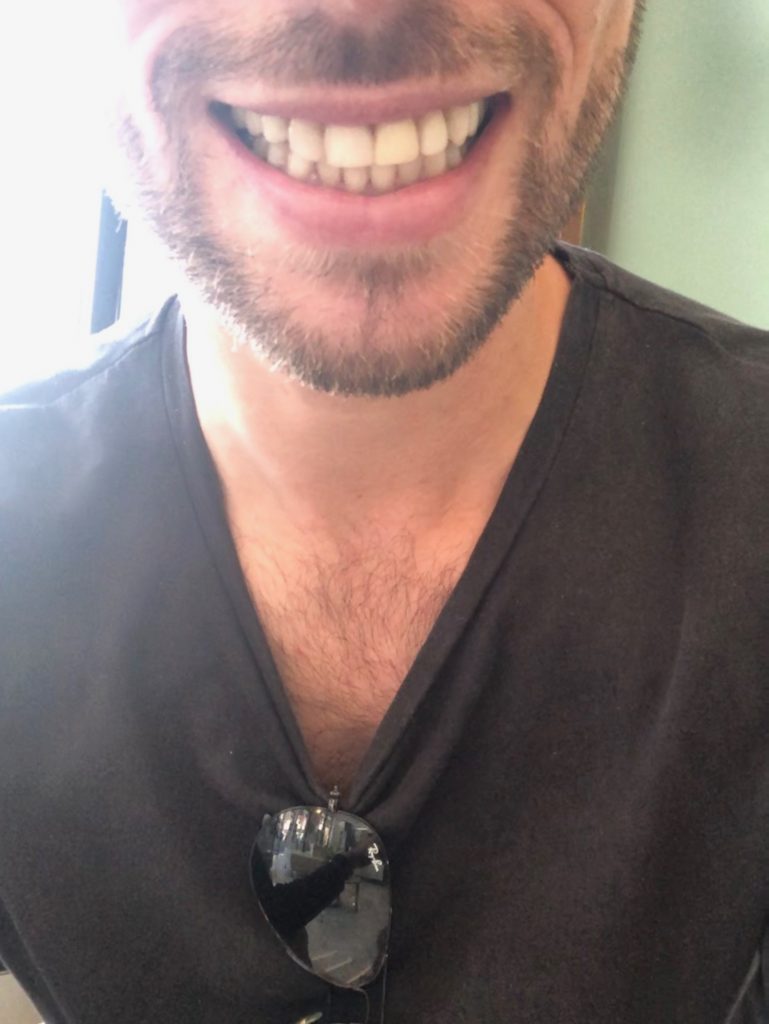 A full set of teeth and an open-mouthed smile after dental surgery