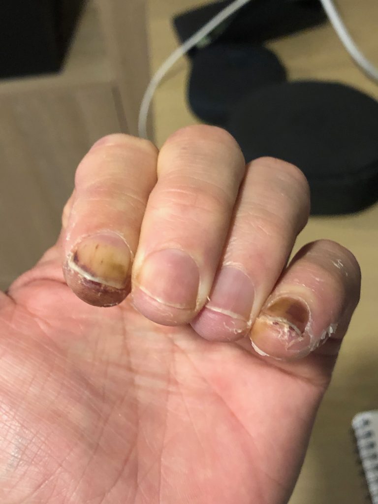 Healing frostbite in four fingers 