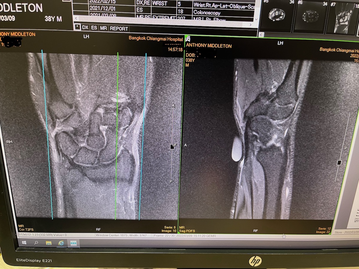 X-ray of a human arm