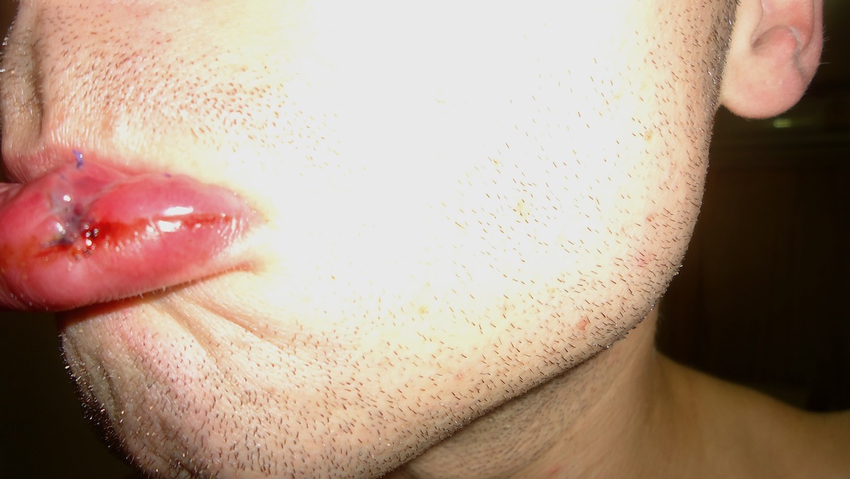 A man's lips with trauma after plastic surgery in Thailand