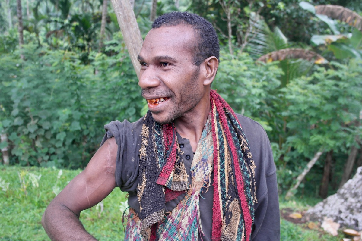 A Papua New Guinea tribesman shows off his battle scars from recent tribal warfare