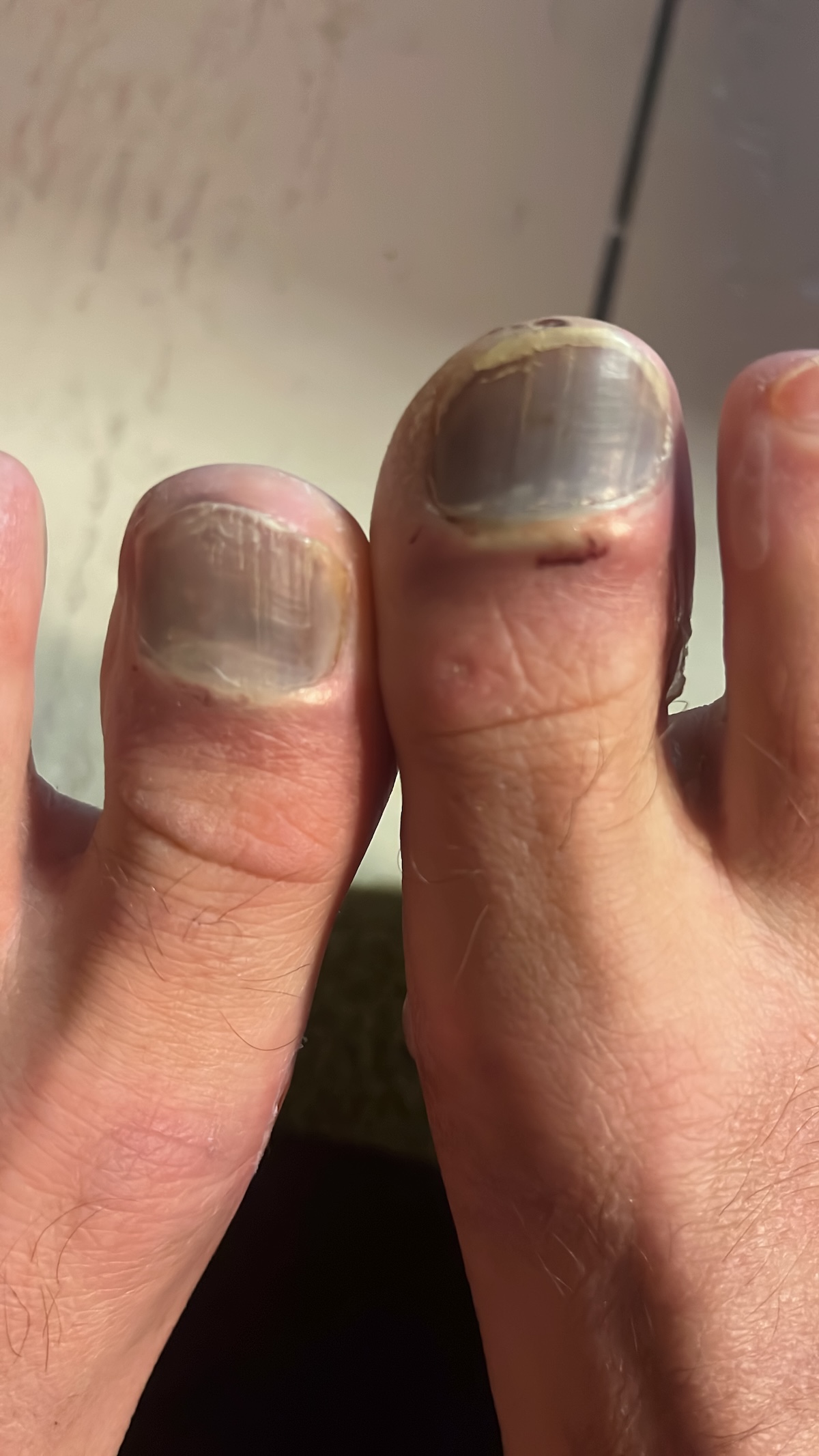 ultramarathon injury